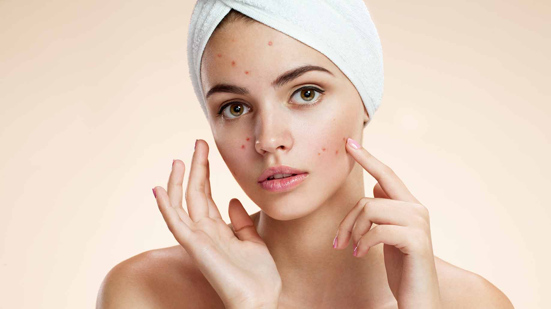 The Diet to Get Rid of Your Acne